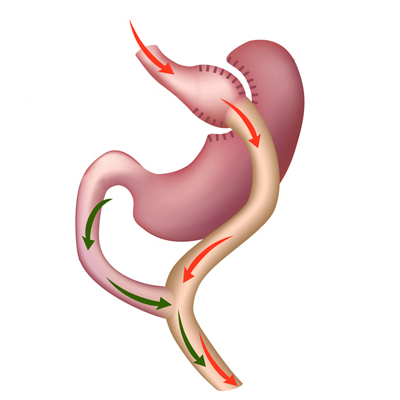 Stomach bypass | Obesity Centre Brussels